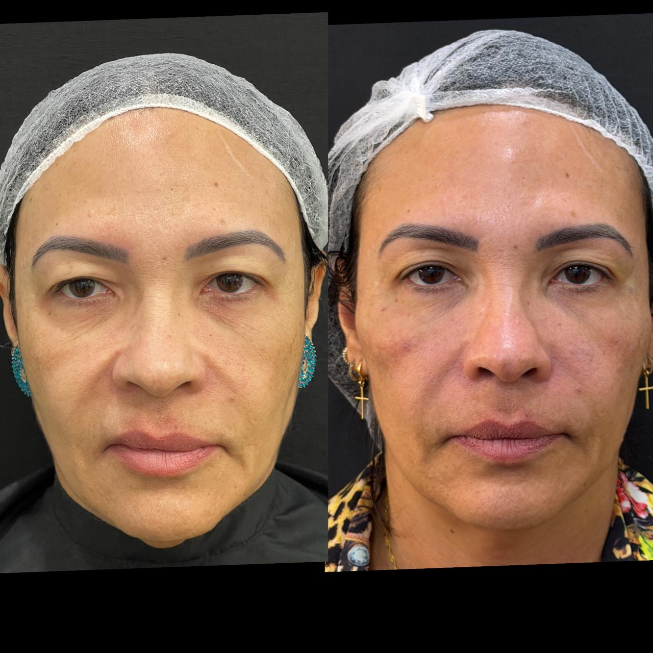 Registro comparativo de harmonização facial em vista frontal, na composição original lado a lado.