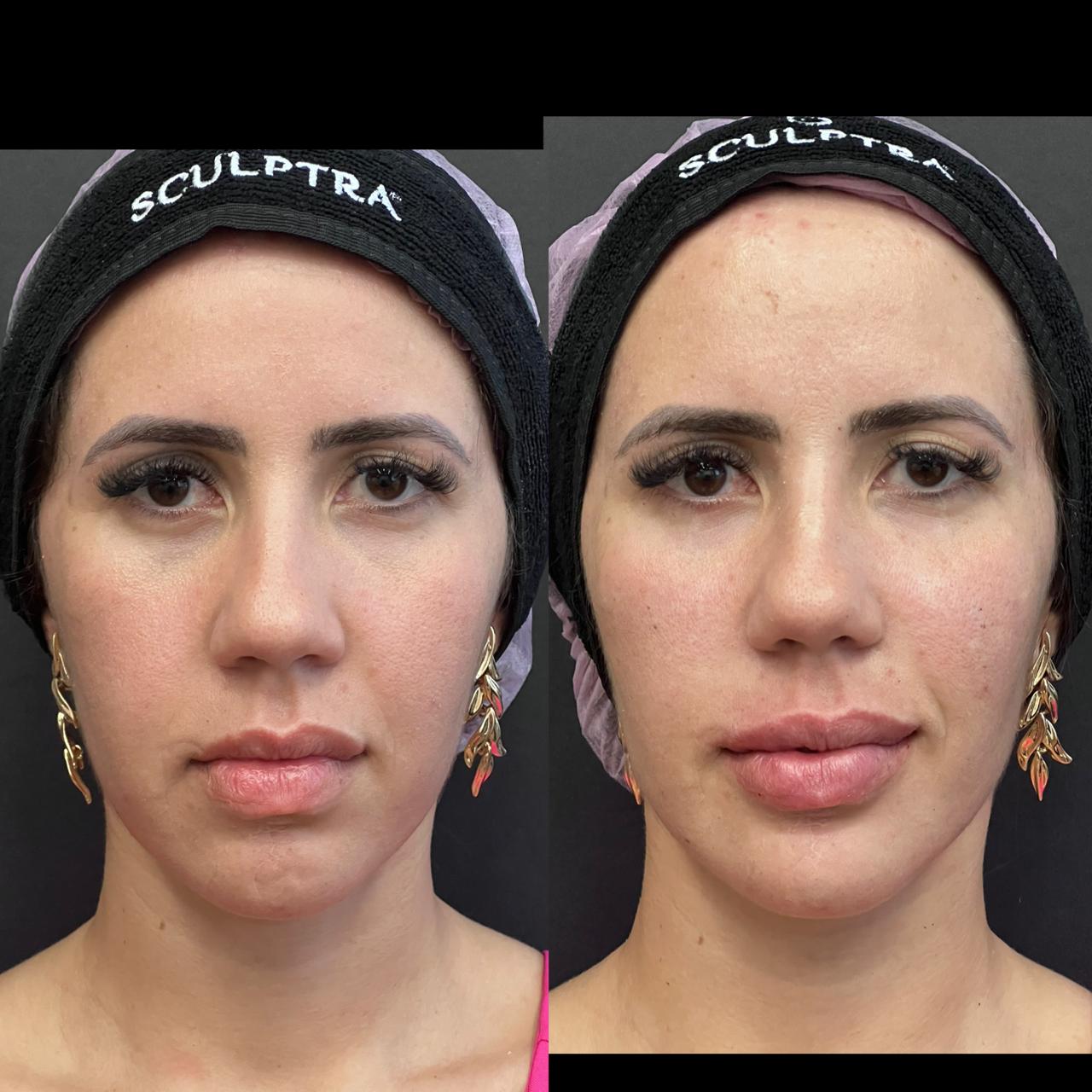Registro comparativo de harmonização facial em vista frontal, preservado na composição original lado a lado.