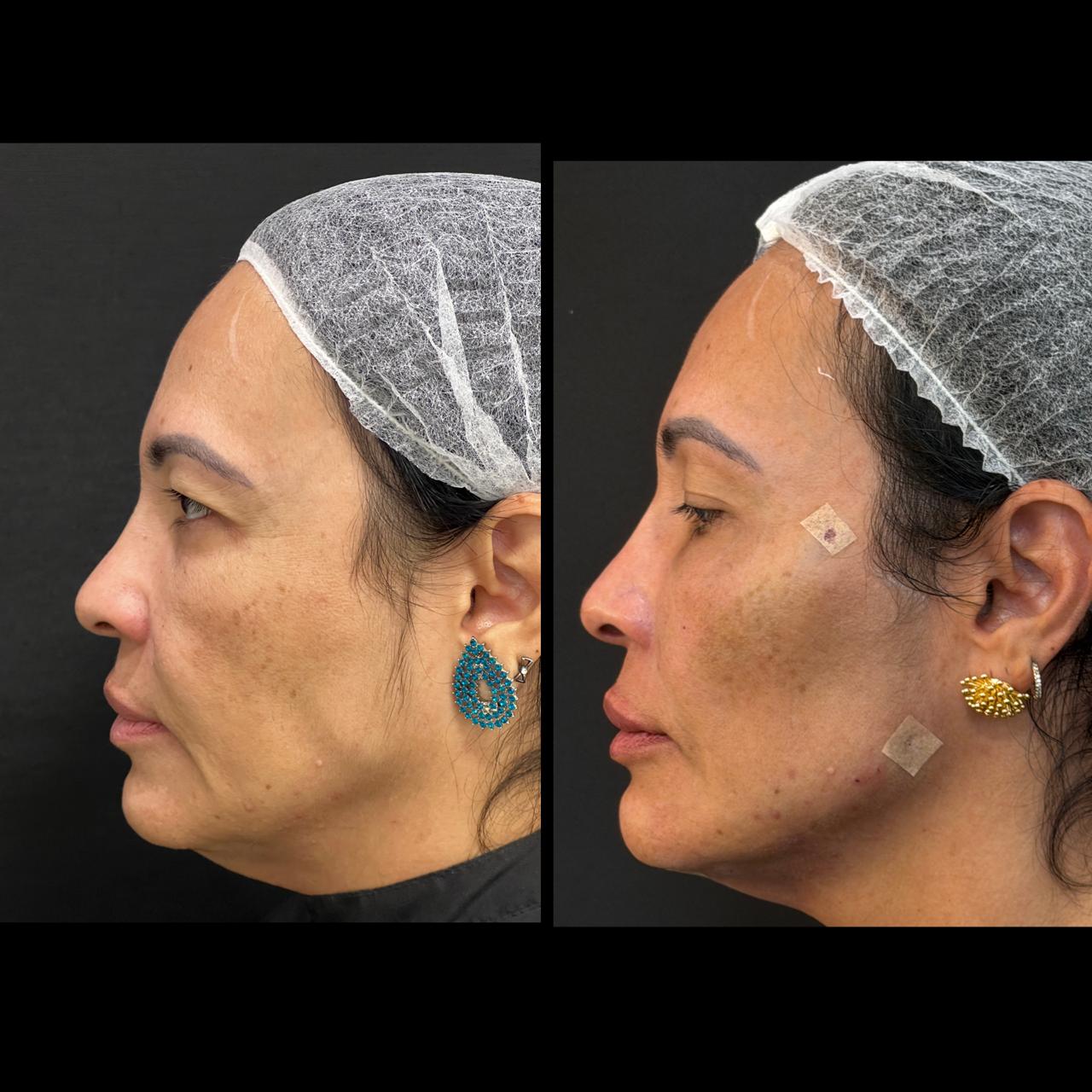 Registro comparativo de harmonização facial em vista de perfil, na composição original lado a lado.