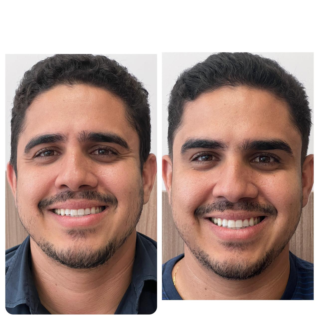 Registro comparativo frontal do procedimento com toxina, na composição original lado a lado.